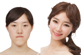 Операция нижней челюсти