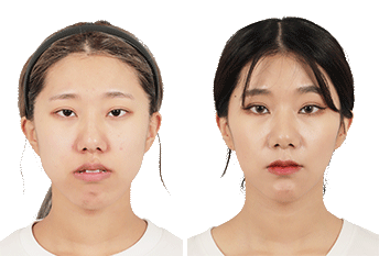 Ортогнатическая операция по методу «операция-первая»