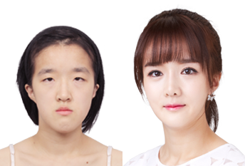 Коррекция выступающего рта без ортогнатического лечения